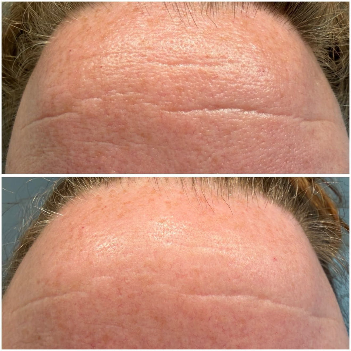 Cassie forehead comparison ten days apart