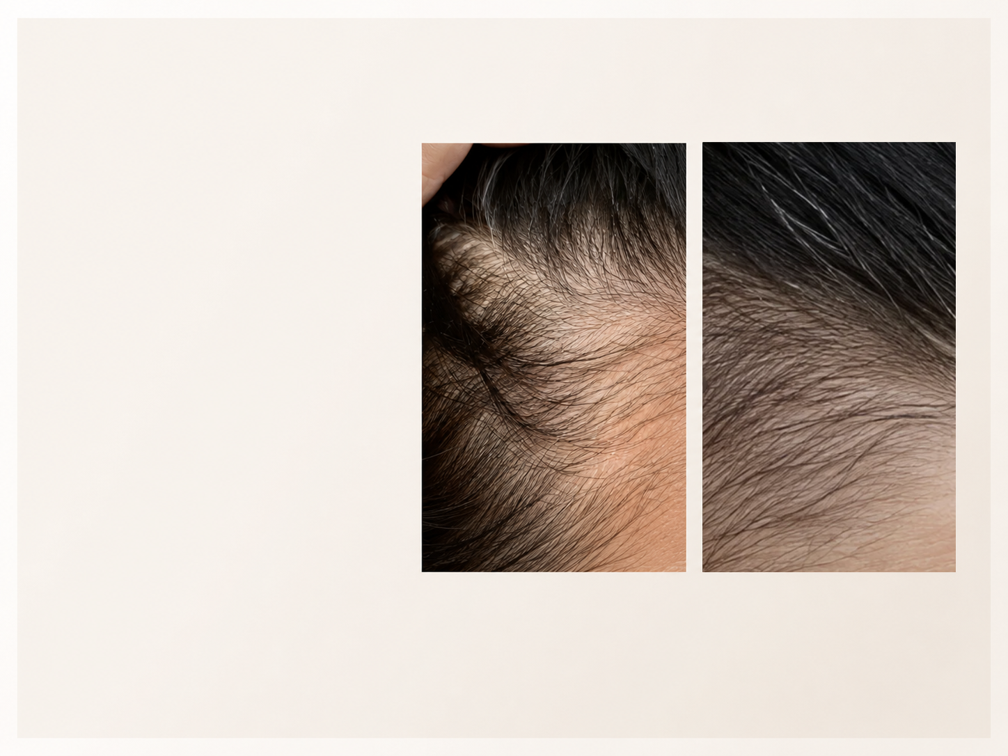 Before and after hair density comparison